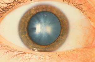 eye cataract and diabetes