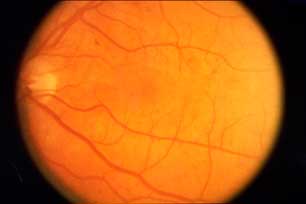 Reverse Diabetes and Prevent Loss of Vision by eye retinopathy