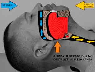 airway